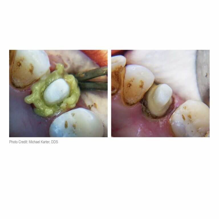 Dryz Gingival Hemostatic Retraction Paste Prestige Dental