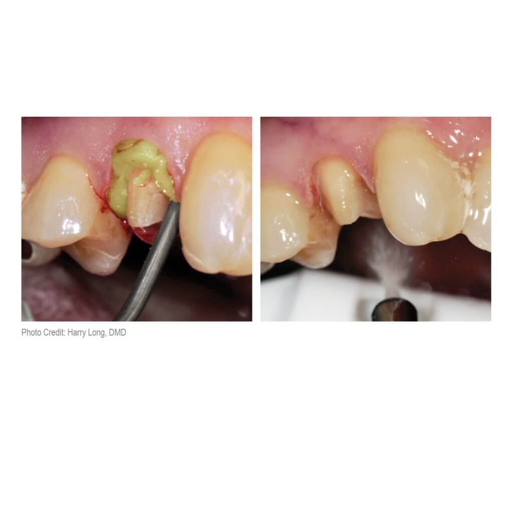 Dryz Gingival Hemostatic Retraction Paste Prestige Dental