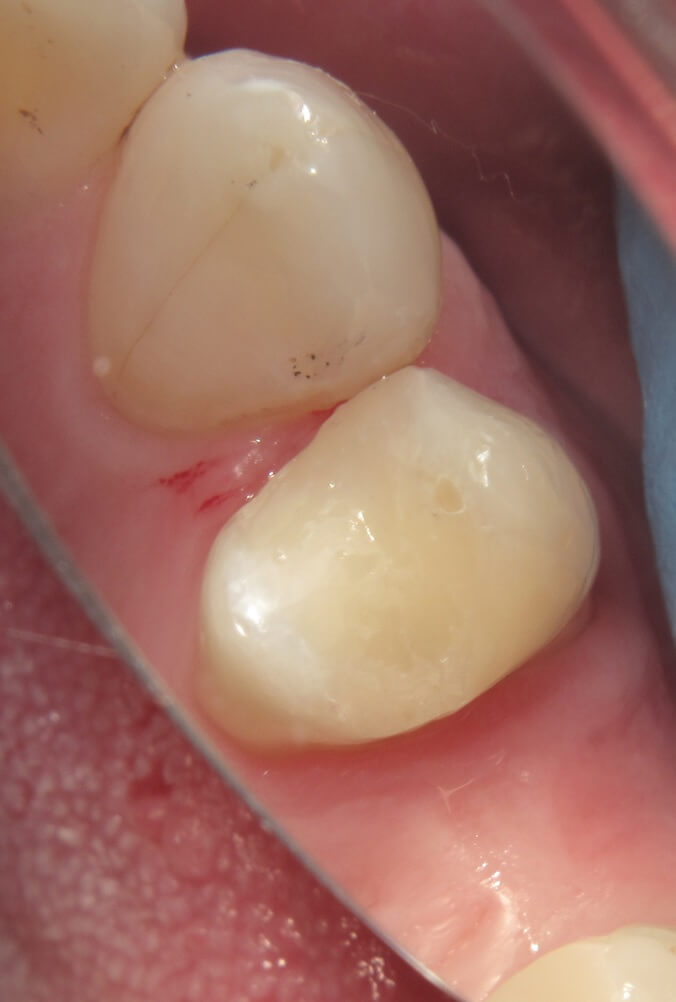 Photo showing teeth prior to treatment with ACTIVA BioACTIVE-RESTORATIVE