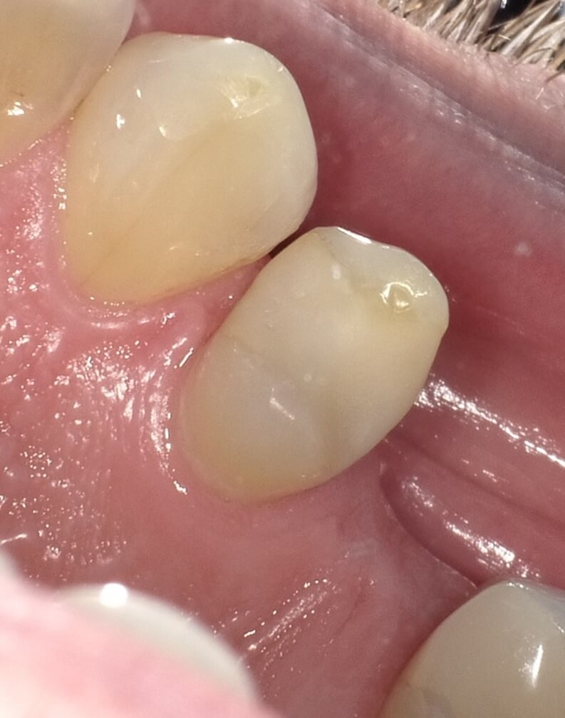 Photo showing teeth treated with ACTIVA BioACTIVE-RESTORATIVE