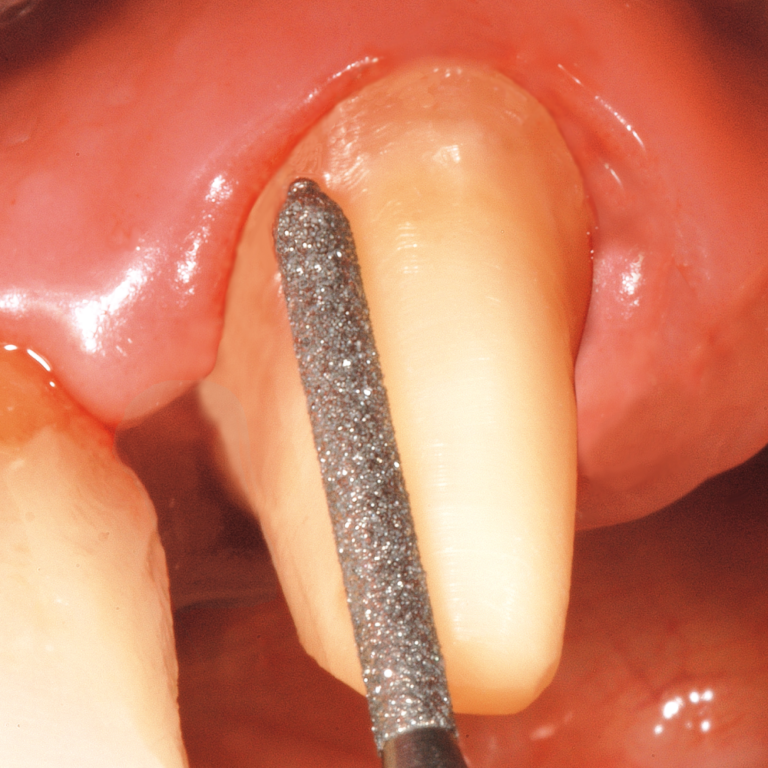 NTI Easy Chamfer Diamond Burs Prestige Dental