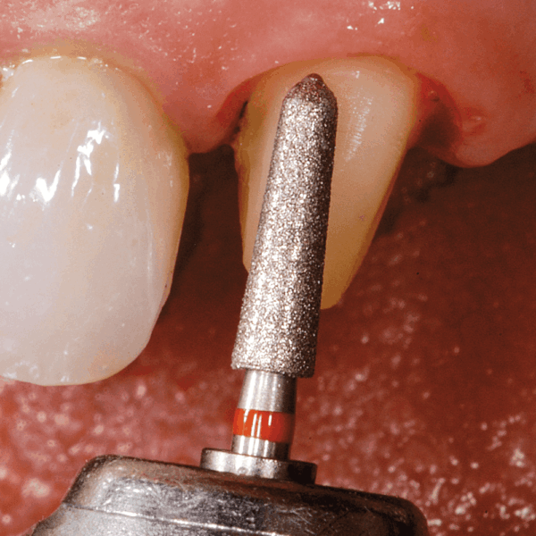 NTI Easy Chamfer Diamond Burs - Image 2